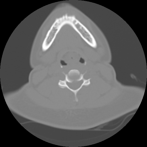 Cervical rib (Radiopaedia 71110-81363 Axial non-contrast 33).jpg