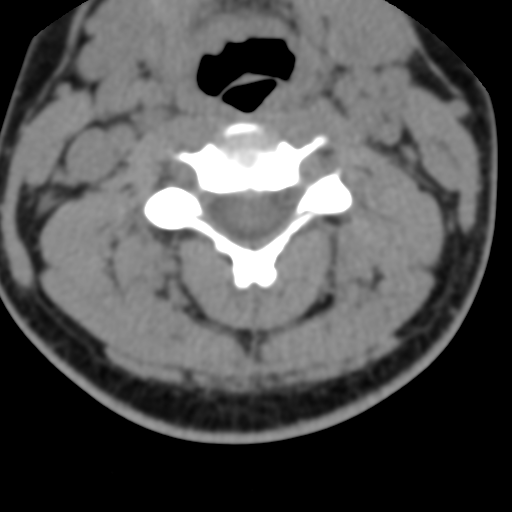 Cervical schwannoma (Radiopaedia 57979-64974 Axial non-contrast 29).png