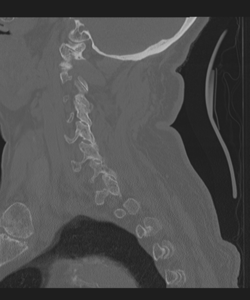 Cervical spine fracture in the setting of ankylosis (Radiopaedia 37038-38715 Sagittal bone window 25).png