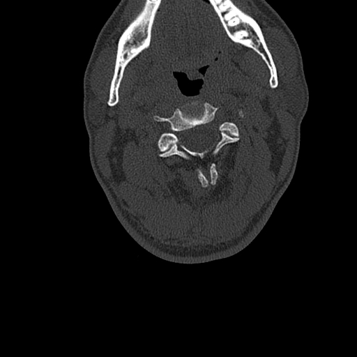 File:Cervical spine trauma with tear drop fracture and perched facet joint (Radiopaedia 53989-60127 Axial bone window 54).jpg