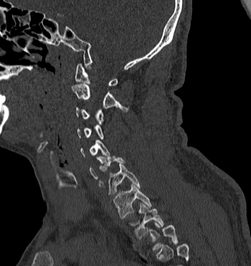 Cervical spine trauma with tear drop fracture and perched facet joint (Radiopaedia 53989-60127 Sagittal bone window 112).jpg