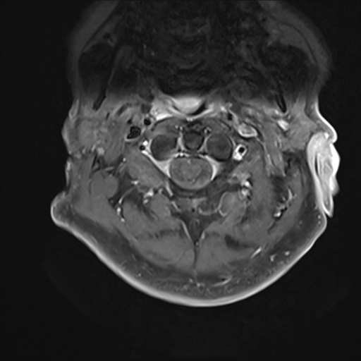 File:Cervical tumor-like myelopathy due to Type V dAVF (Radiopaedia 82461-96604 Axial T1 C+ fat sat 6).jpg