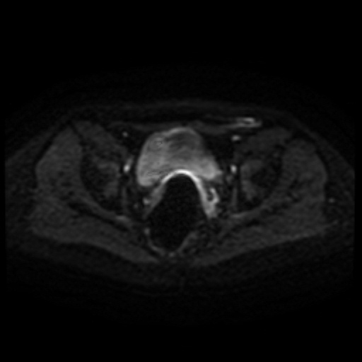 File:Cesarian section scar endometriosis (Radiopaedia 66520-75799 Axial DWI 40).jpg