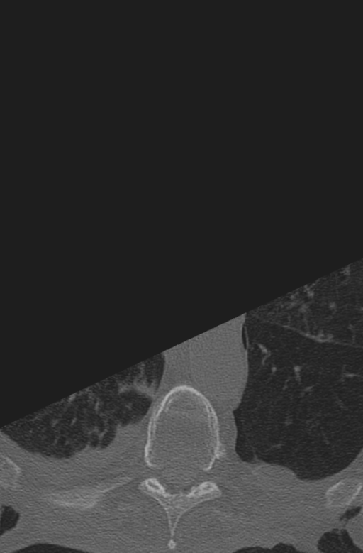 Chalk stick fracture (Radiopaedia 57948-64928 Axial bone window 76).png
