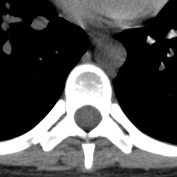 Chance fracture (Radiopaedia 36521-38081 Axial non-contrast 16).jpg