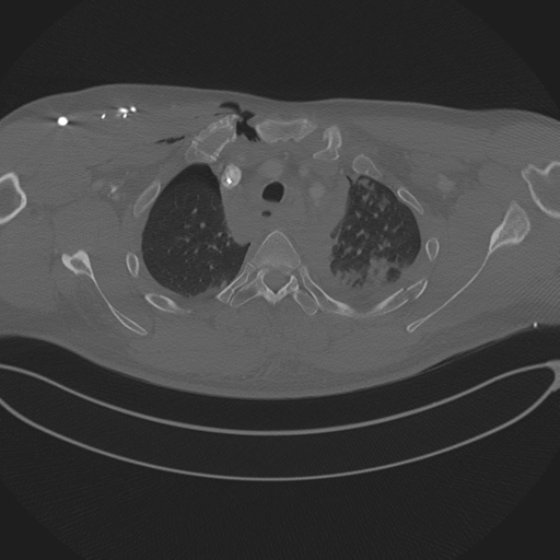 Chest multitrauma - aortic injury (Radiopaedia 34708-36147 Axial bone window 62).png