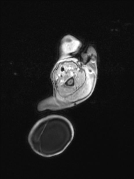 Chiari III malformation with occipital encephalocele (Radiopaedia 79446-92559 Axial T1 C+ mpr 14).jpg