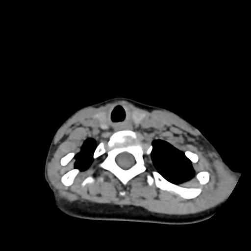 Chiari I with syrinx and skull base anomalies (Radiopaedia 89444-106412 Axial non-contrast 119).jpg