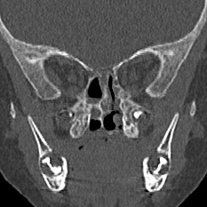 File:Choanal atresia (Radiopaedia 88525-105975 Coronal bone window 65).jpg