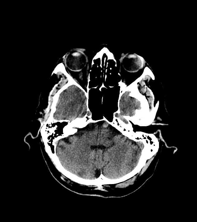 Cholangiocarcinoma with cerebral metastases (Radiopaedia 83519-98628 Axial non-contrast 20).jpg