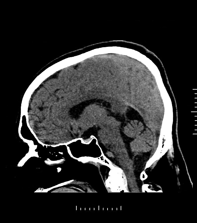 Cholangiocarcinoma with cerebral metastases (Radiopaedia 83519-98628 C 26).jpg