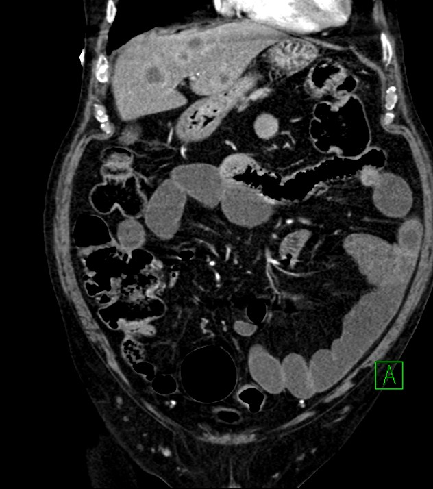 Cholangiocarcinoma with cerebral metastases (Radiopaedia 83519-98629 E 30).jpg