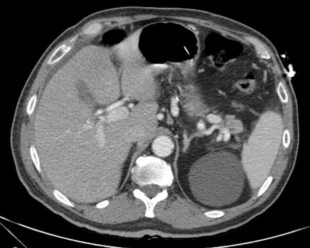 Cholecystitis - perforated gallbladder (Radiopaedia 57038-63916 A 22).jpg