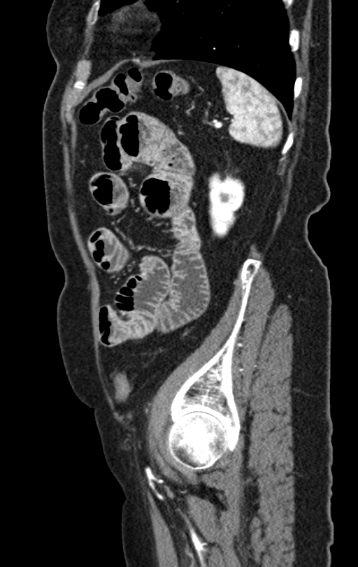 Cholecystoduodenal fistula due to calculous cholecystitis with gallstone migration (Radiopaedia 86875-103077 C 13).jpg