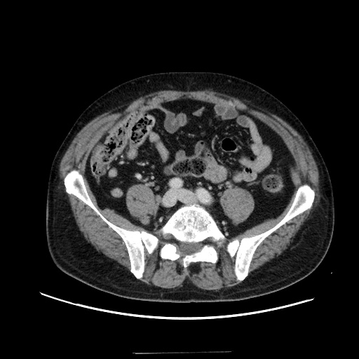 Choledocholiathiasis with normal caliber common bile duct (Radiopaedia 75368-86632 A 131).jpg