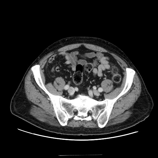 Choledocholiathiasis with normal caliber common bile duct (Radiopaedia 75368-86632 A 145).jpg