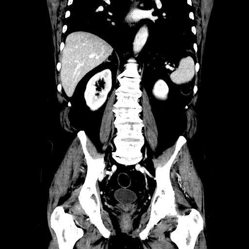 Choledocholiathiasis with normal caliber common bile duct (Radiopaedia 75368-86632 Coronal liver window 83).jpg