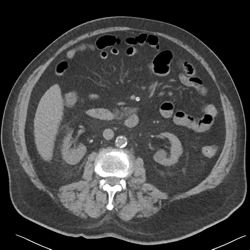 File:Choledocholithiasis and gastric polyp (Radiopaedia 48856-53895 Axial non-contrast 41).png