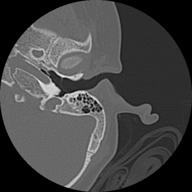 Cholesteatoma (Radiopaedia 73023-83750 Axial Left ear 24).jpg