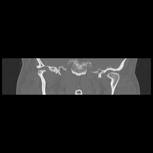 Cholesteatoma (Radiopaedia 84946-100455 Coronal bone window 85).jpg