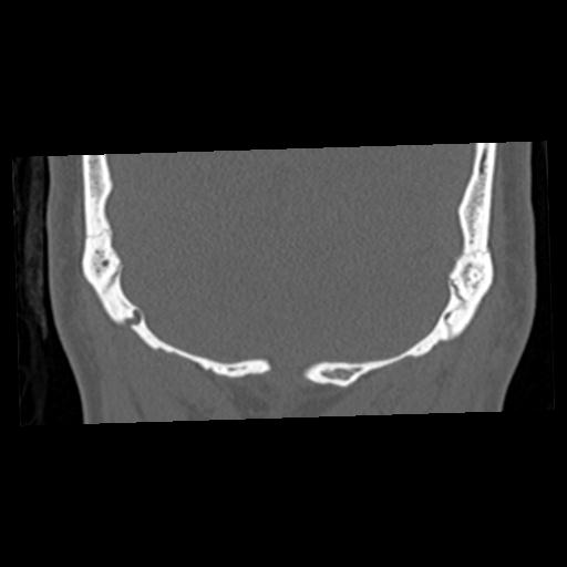 Cholesteatoma (Radiopaedia 84960-100474 Coronal bone window 69).jpg