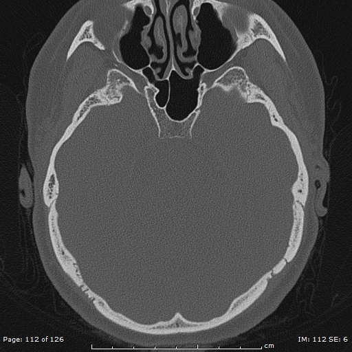 Cholesteatoma - external auditory canal (Radiopaedia 88452-105096 Axial bone window 75).jpg