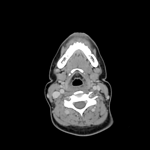 File:Chondroblastic osteosarcoma (Radiopaedia 67363-76741 Axial with contrast 16).jpg
