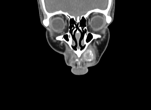 Chondroblastic osteosarcoma (Radiopaedia 67363-76741 D 17).jpg