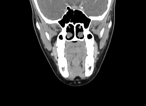 Chondroblastic osteosarcoma (Radiopaedia 67363-76741 D 44).jpg