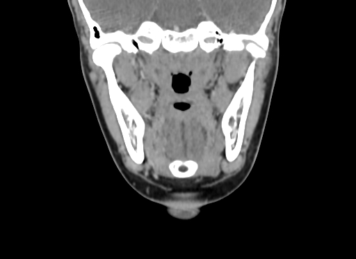 Chondroblastic osteosarcoma (Radiopaedia 67363-76741 D 58).jpg