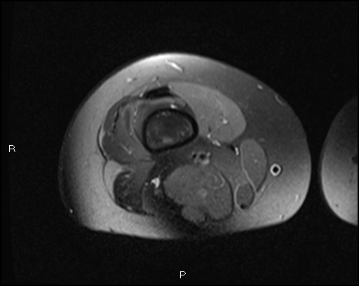 File:Chondroblastoma (Radiopaedia 62721-71031 Axial PD fat sat 1).jpg