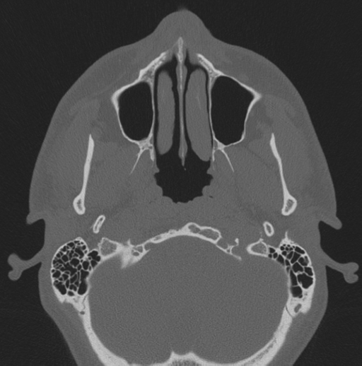 Chondrosarcoma (clivus) (Radiopaedia 46895-51425 Axial bone window 68).png