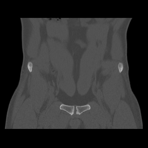 Chondrosarcoma of iliac wing (Radiopaedia 63861-72599 Coronal bone window 31).jpg