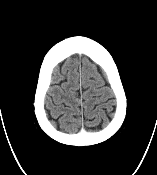 File:Chondrosarcoma of skull base- grade II (Radiopaedia 40948-43653 Axial Contrast 26).png
