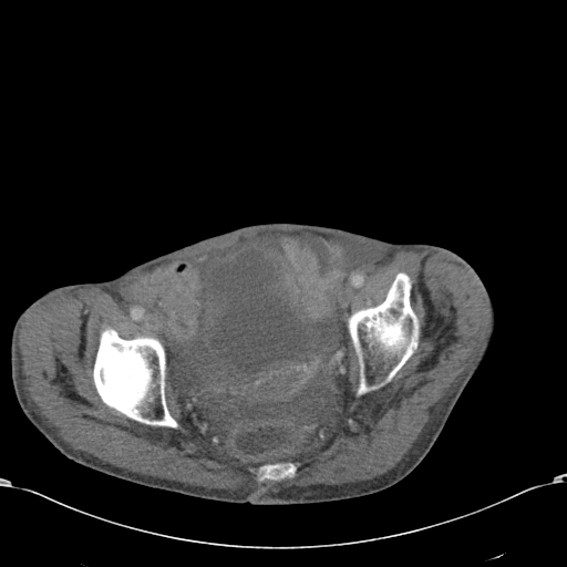 Chondrosarcoma of the spine (Radiopaedia 49871-55143 A 57).jpg