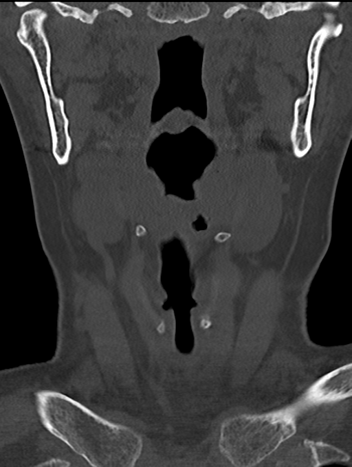 Chordoma (C4 vertebra) (Radiopaedia 47561-52188 Coronal bone window 1).png