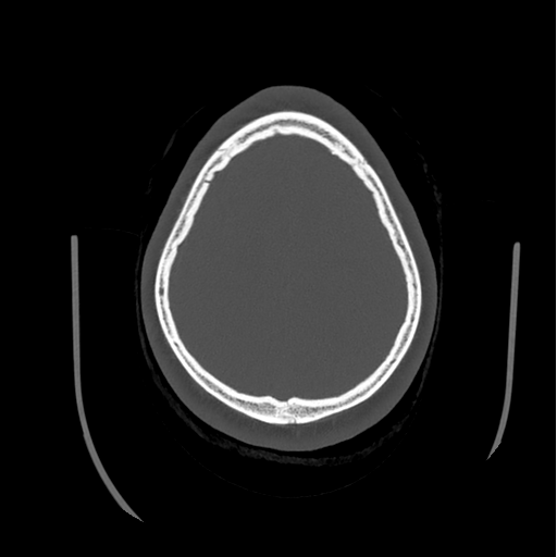 Choroid plexus papilloma extending into the cerebellopontine angle cistern (Radiopaedia 85941-101833 Axial bone window 77).png