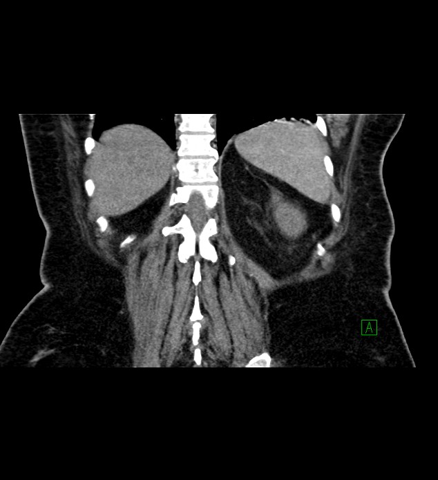 Chromophobe renal cell carcinoma (Radiopaedia 84239-99519 C 71).jpg