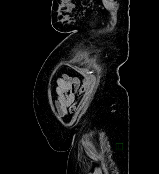 Chromophobe renal cell carcinoma (Radiopaedia 84239-99519 G 12).jpg