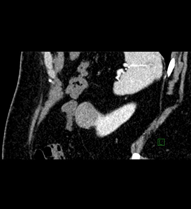 Chromophobe renal cell carcinoma (Radiopaedia 84286-99573 F 26).jpg