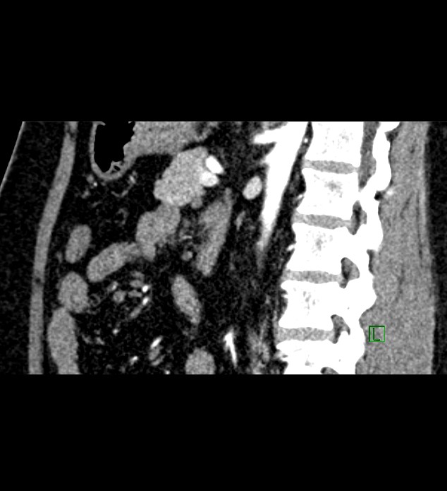 Chromophobe renal cell carcinoma (Radiopaedia 84286-99573 F 74).jpg