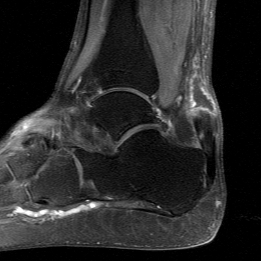 File:Chronic Achilles tendon rupture (Radiopaedia 15262-15100 C 6).jpg