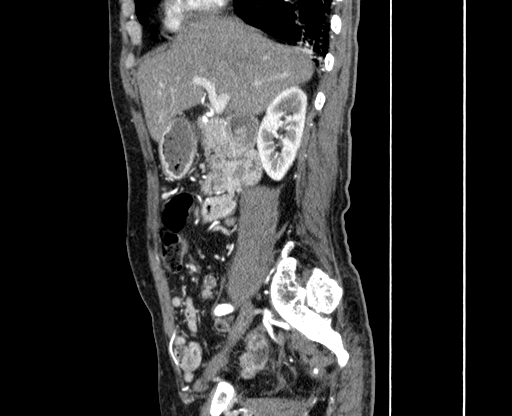 Chronic contained rupture of abdominal aortic aneurysm with extensive erosion of the vertebral bodies (Radiopaedia 55450-61901 B 6).jpg