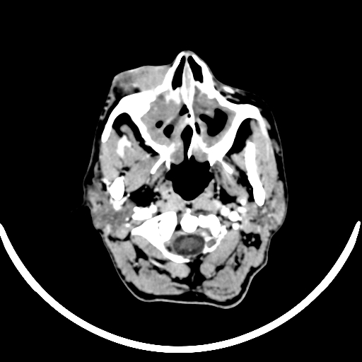 Chronic invasive fungal sinusitis with intraorbital and intracranial extension (Radiopaedia 56387-63046 B 37).jpg