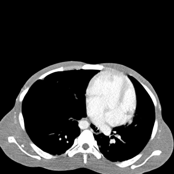 Chronic large bowel pseudo-obstruction (Radiopaedia 43181-46492 A 18).jpg