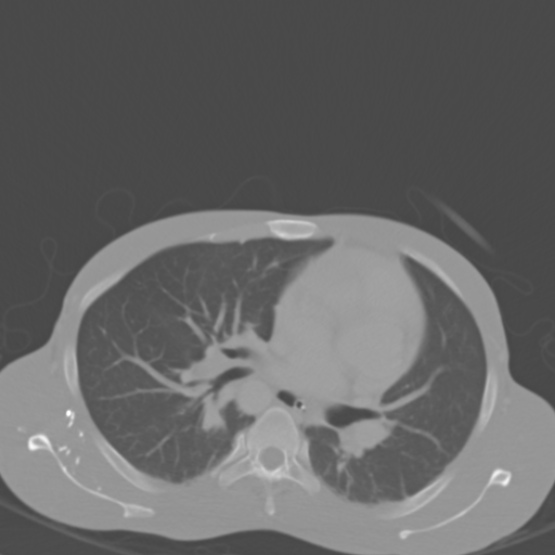 File:Chronic large bowel pseudo-obstruction (Radiopaedia 43181-46492 Axial bone window 11).jpg