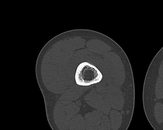 Chronic ostemyelitis of the femur with long sinus tract (Radiopaedia 74947-85982 Axial bone window 125).jpg