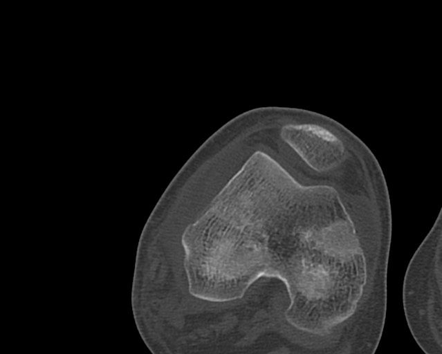 Chronic ostemyelitis of the femur with long sinus tract (Radiopaedia 74947-85982 Axial bone window 216).jpg