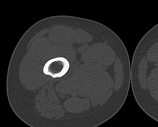 Chronic ostemyelitis of the femur with long sinus tract (Radiopaedia 74947-85982 Axial bone window 50).jpg