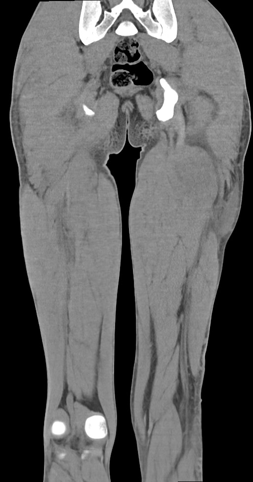 Chronic osteomyelitis (with sequestrum) (Radiopaedia 74813-85822 E 43).jpg